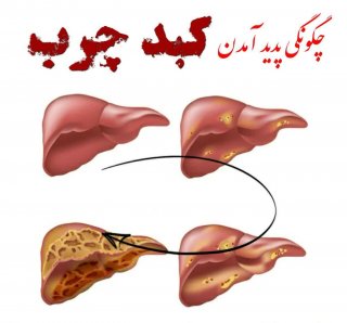 #کبد_چرب چیست و چگونه ایجاد می شود ؟